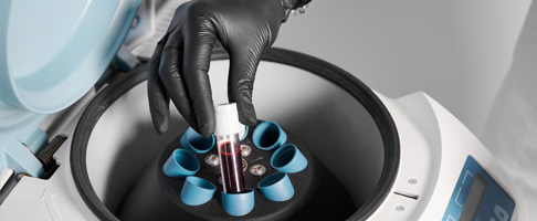 PRP ve Ozon: İki Güçlü Tedavi Yönteminin Birleşimi