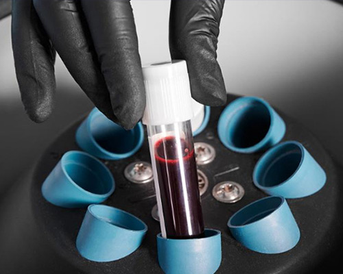 PRP and Ozone: The Synergy of Two Powerful Treatment Methods